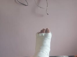 नाहन में बंदरों का आतंक: स्कूल से लौट रहे 8वीं कक्षा के स्टूडेंट पर किया हमला, बच्चे को आया पैर में फ्रैक्चर